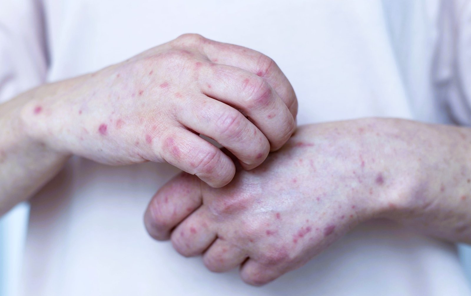 actinic keratosis