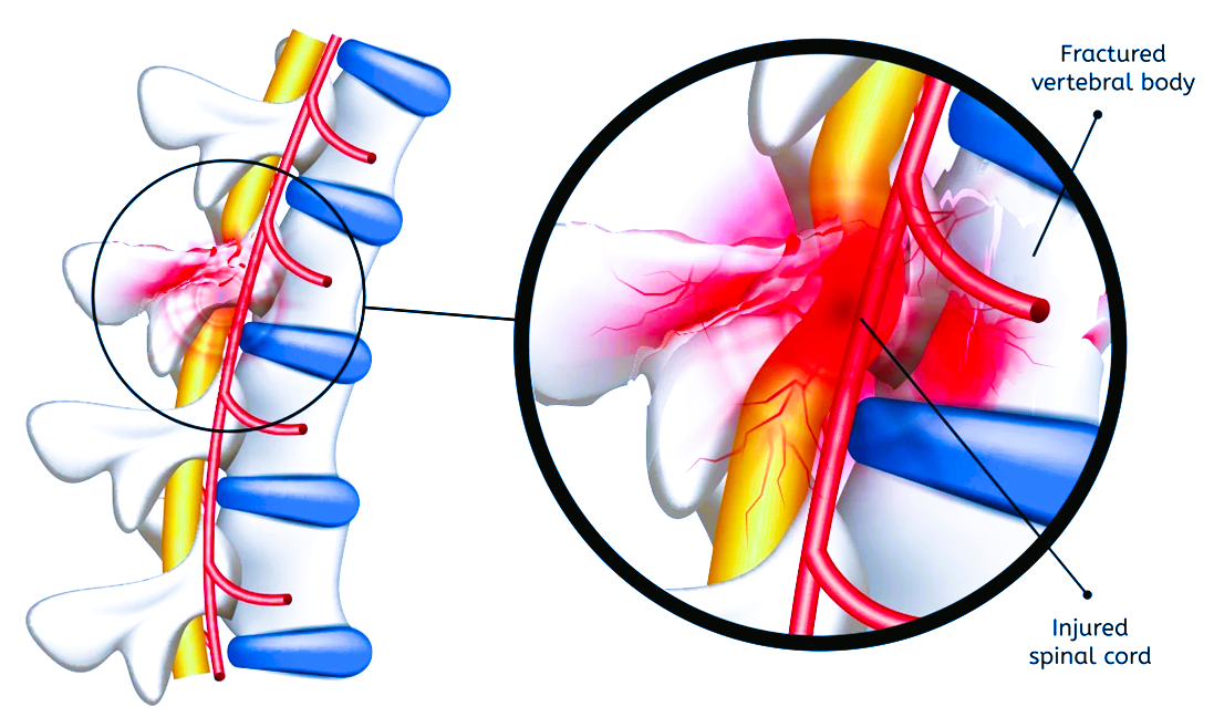 spinal cord injury