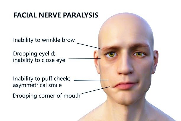bells palsy