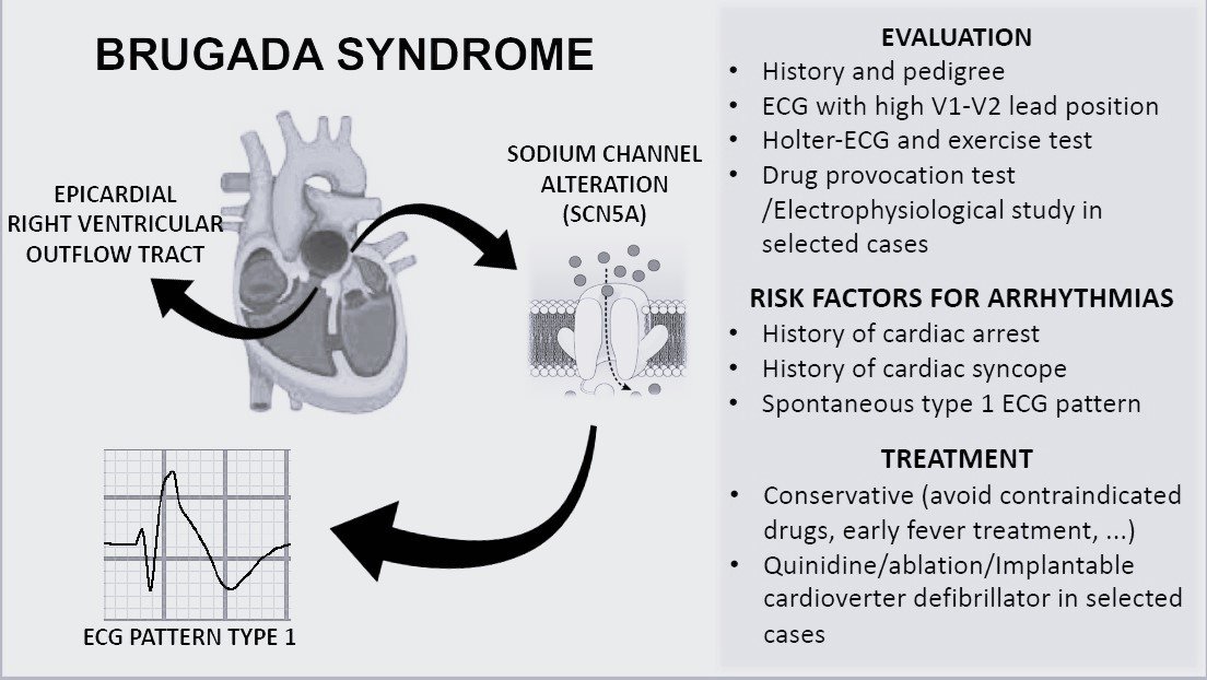 Brugada Syndrome