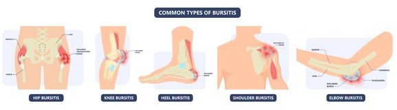 borsitis