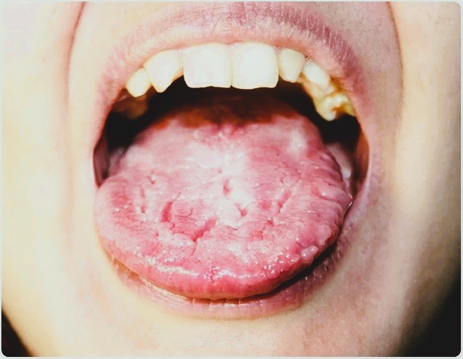 Candidiasis