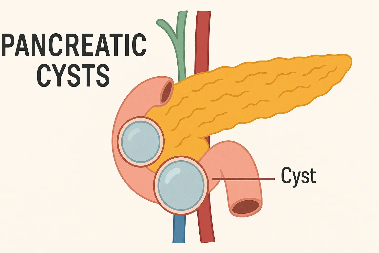 Pancreatic cysts
