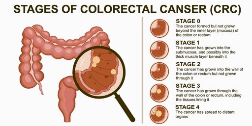 rectal cancer