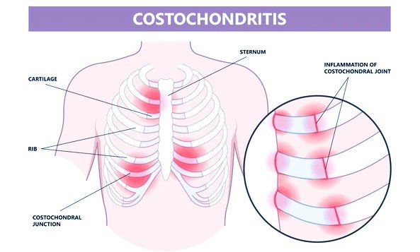 costochondritis