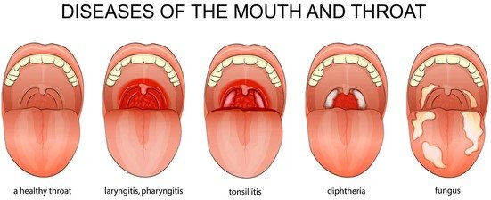 diphtheria