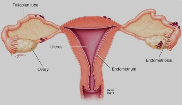ENDOMETRIOSIS