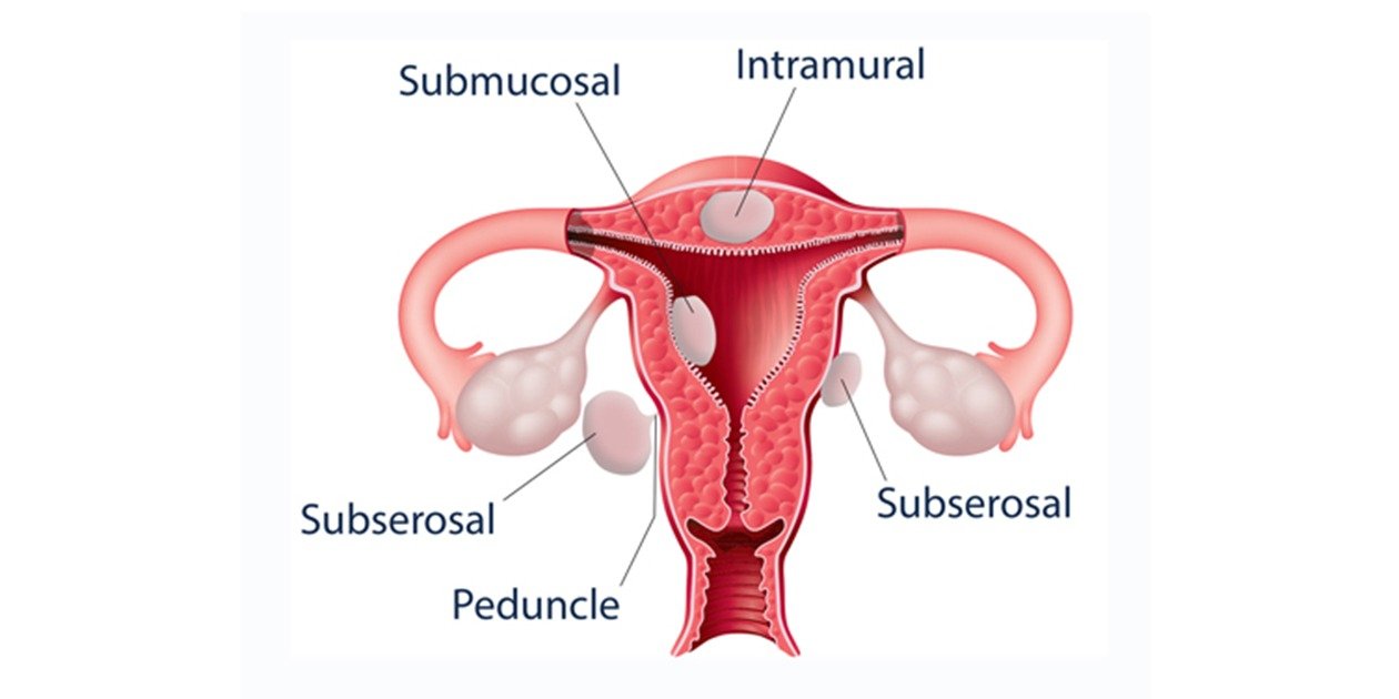Uterine fibroids