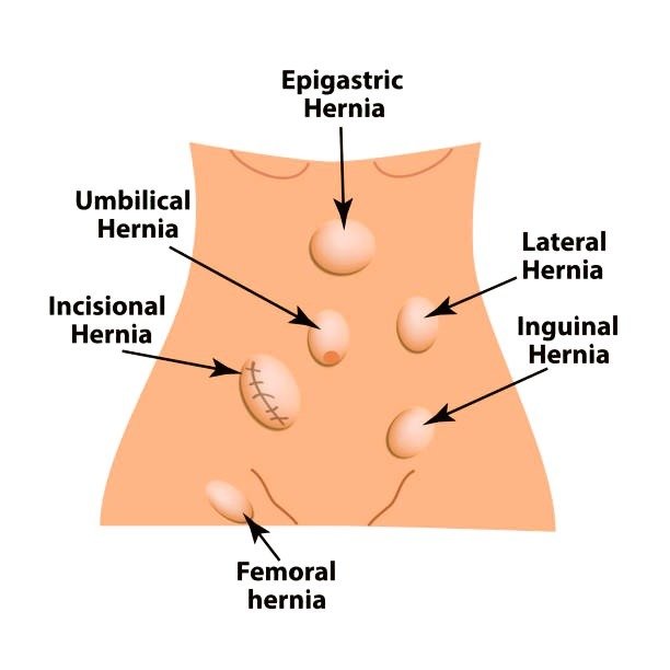 Hernia
