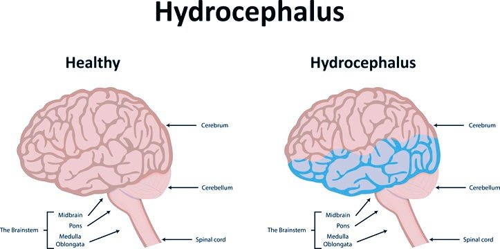 Hydrocephalus