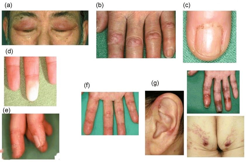 lung disease
