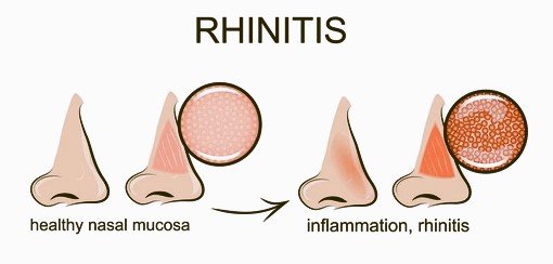 rhinitis