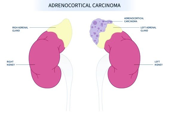 adrenocortical carcinoma