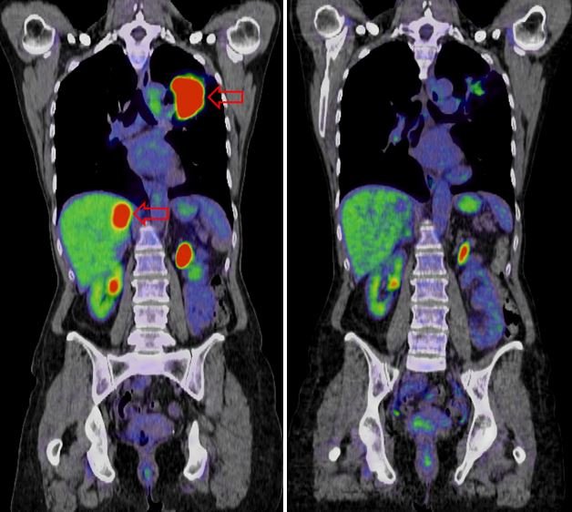 liver cancer