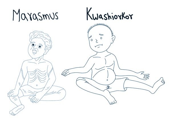 Marasmus