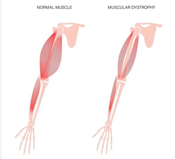 Muscular dystrophy