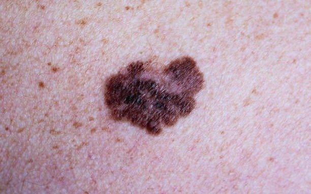 Melanoma