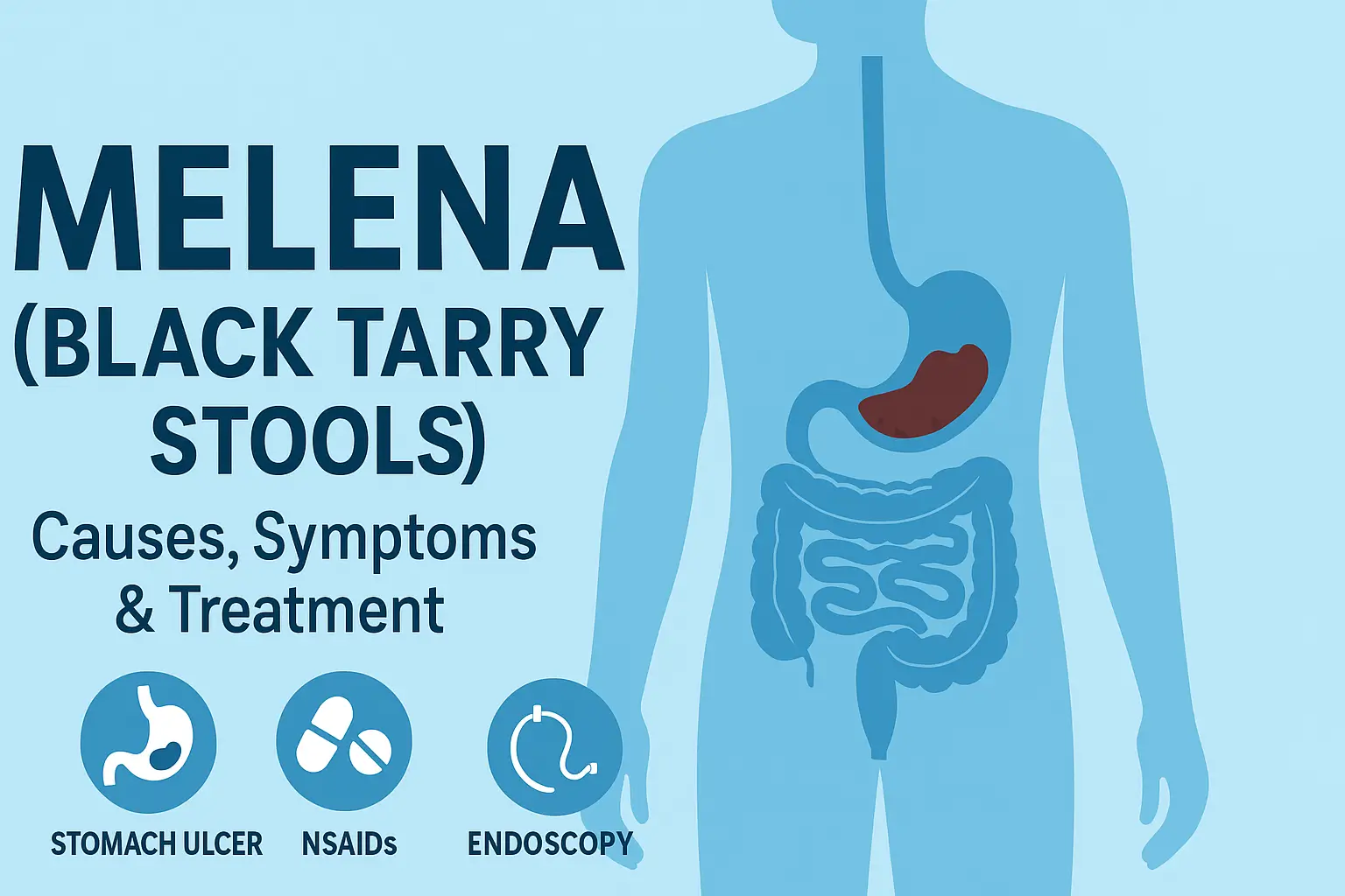 Illustration of melena showing black tarry stools caused by upper gastrointestinal bleeding,
