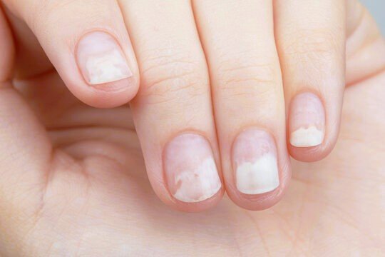 onycholysis