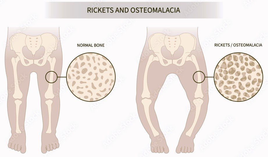 Pagets Disease