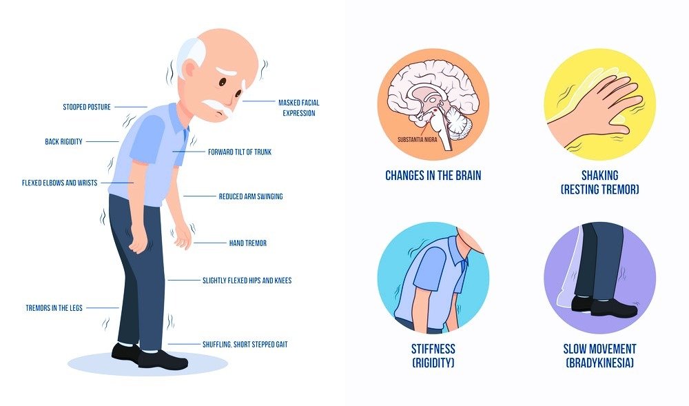 Parkinsons Disease