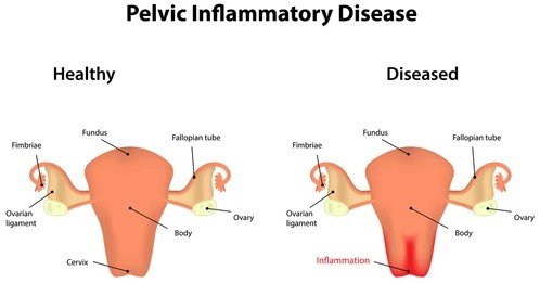 pelvic inflammatory disease
