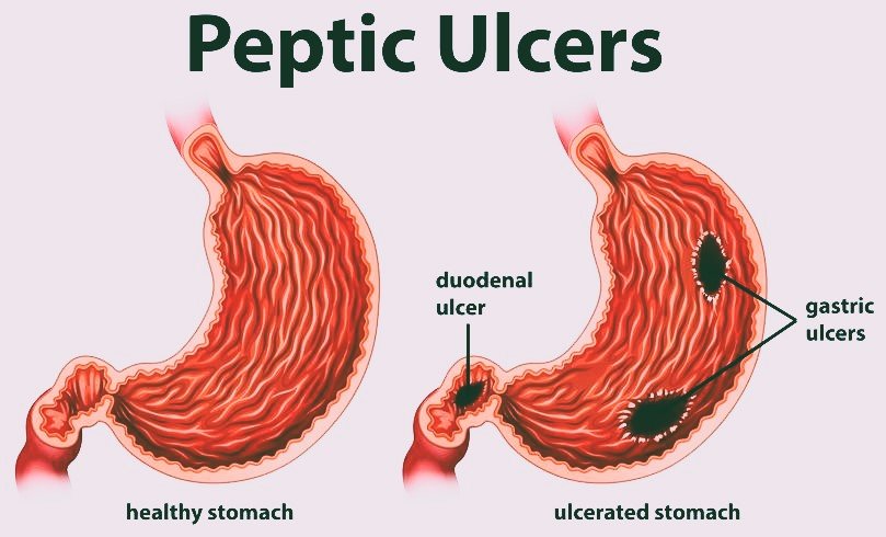 peptic ulcers