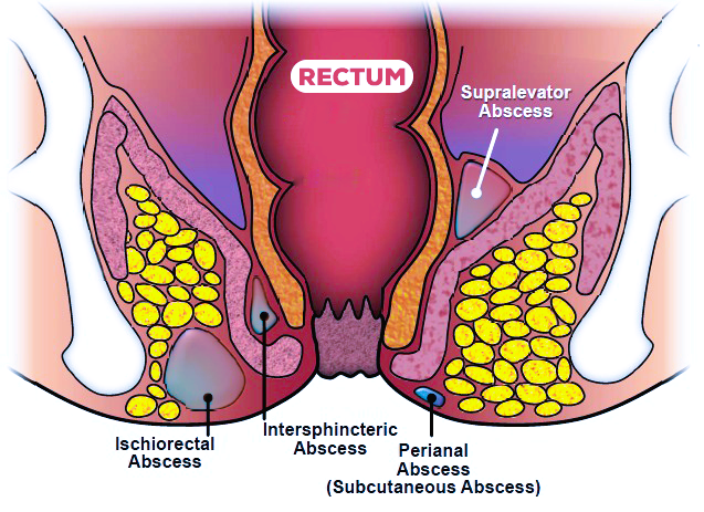 Perianal Abscesses