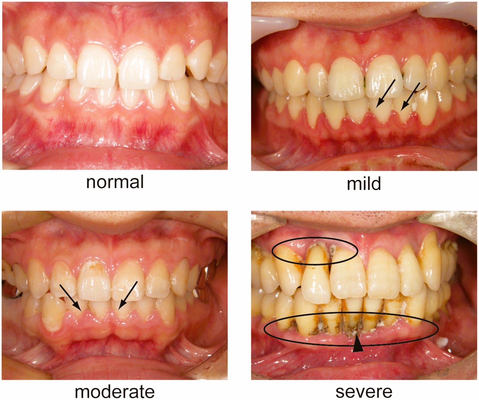 Periodontal disease