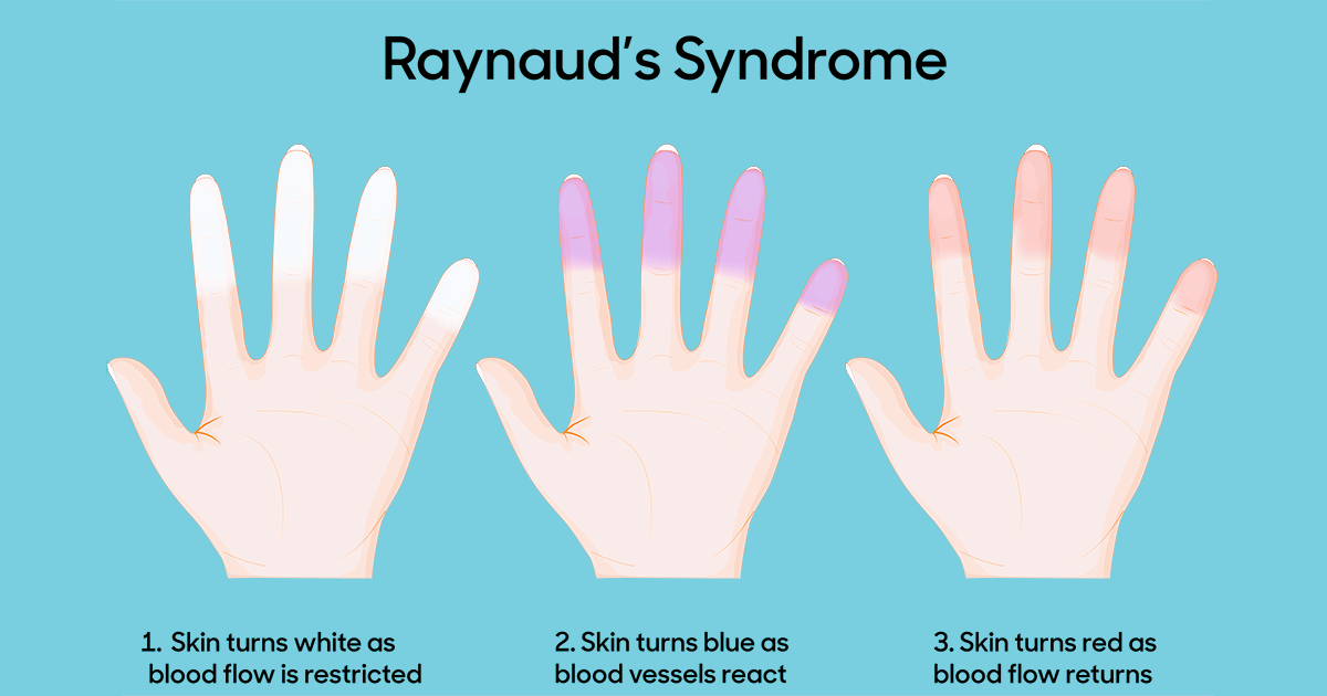 ray-syndrome