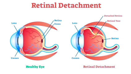 Retinal Disorders