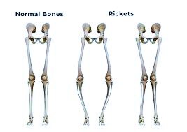 rickets