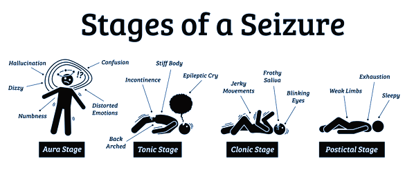 Epilepsy and Seizures
