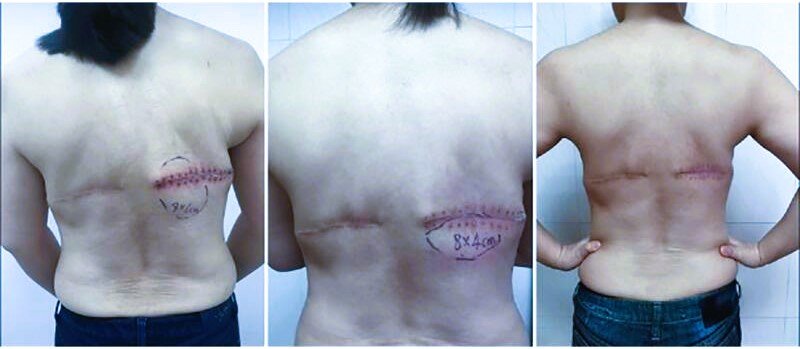 seroma