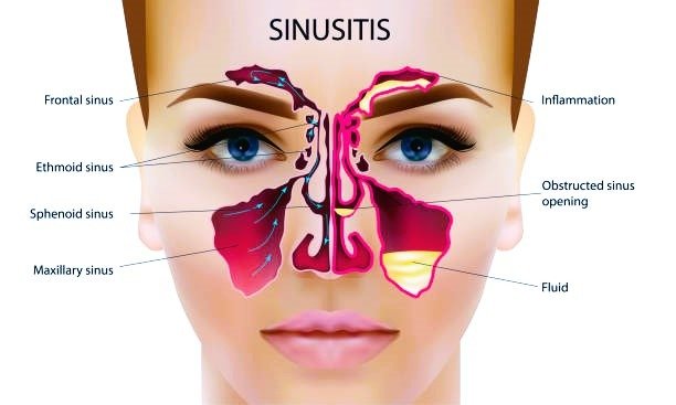 Sinusitis image