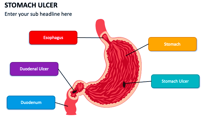stomach ulcer