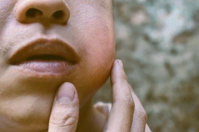 mumps