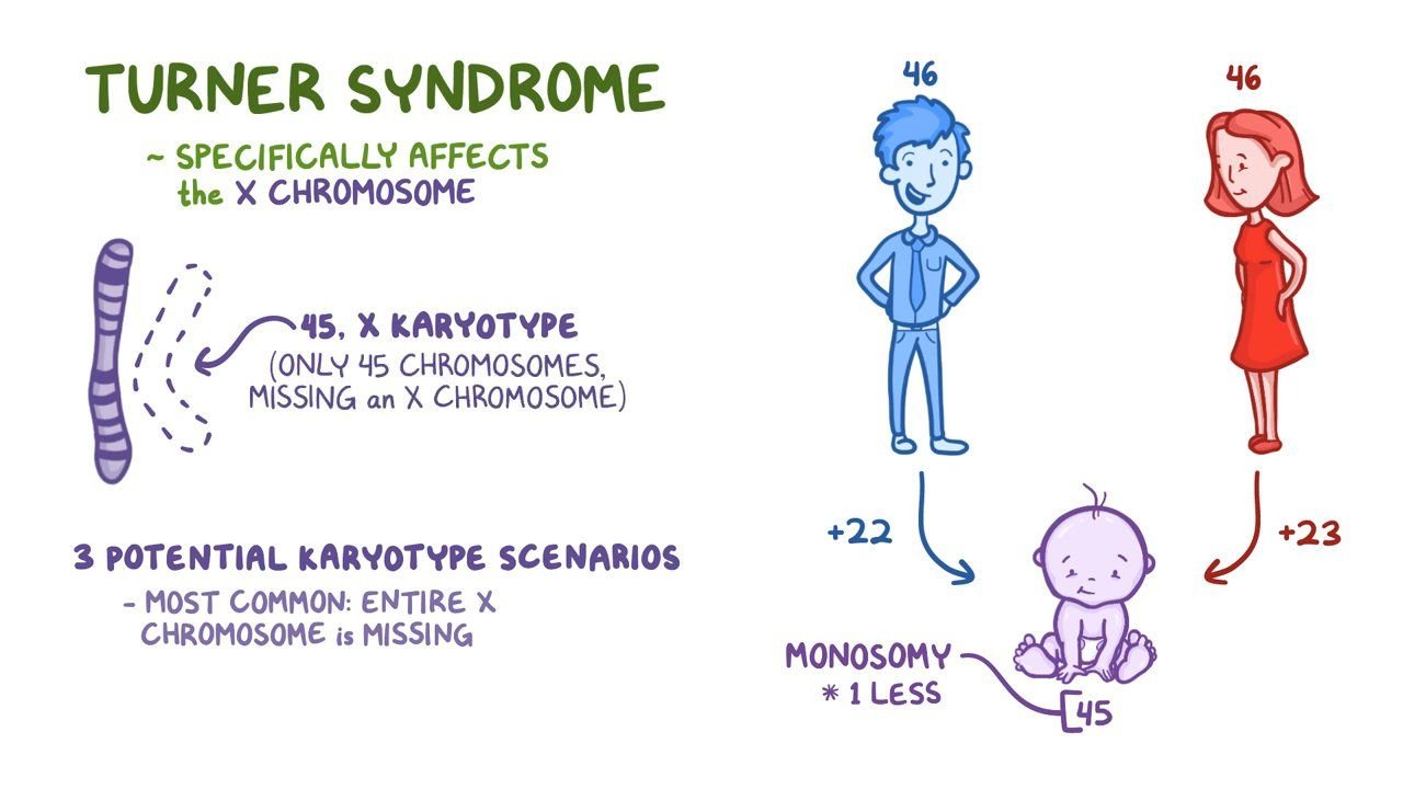 turner syndrome