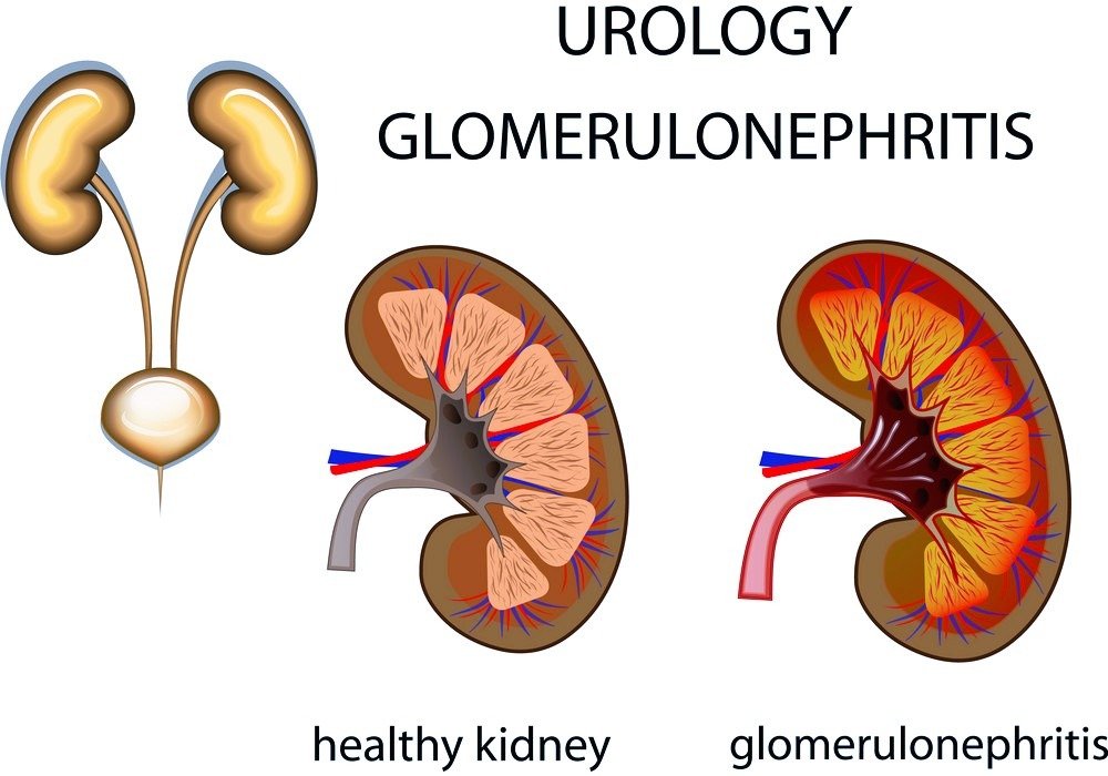 glomerulonephritis