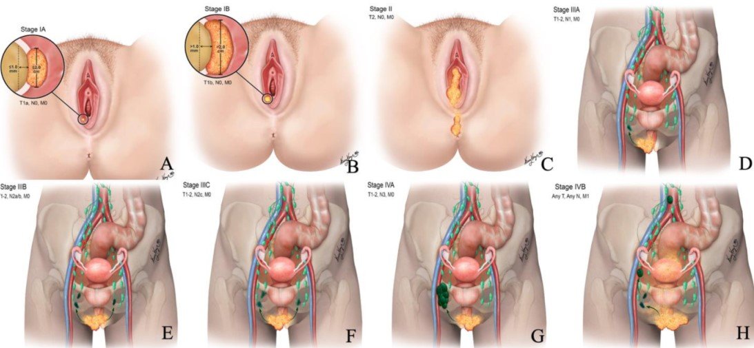 vulvar cancer